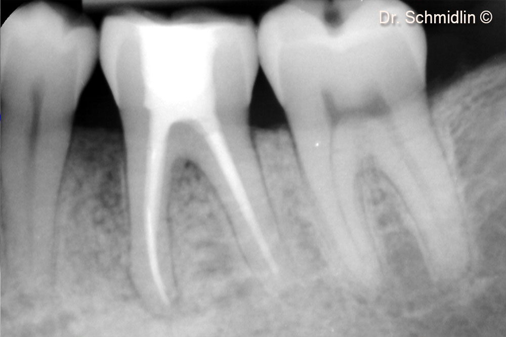Periodontal probing of the affected site after 6 months