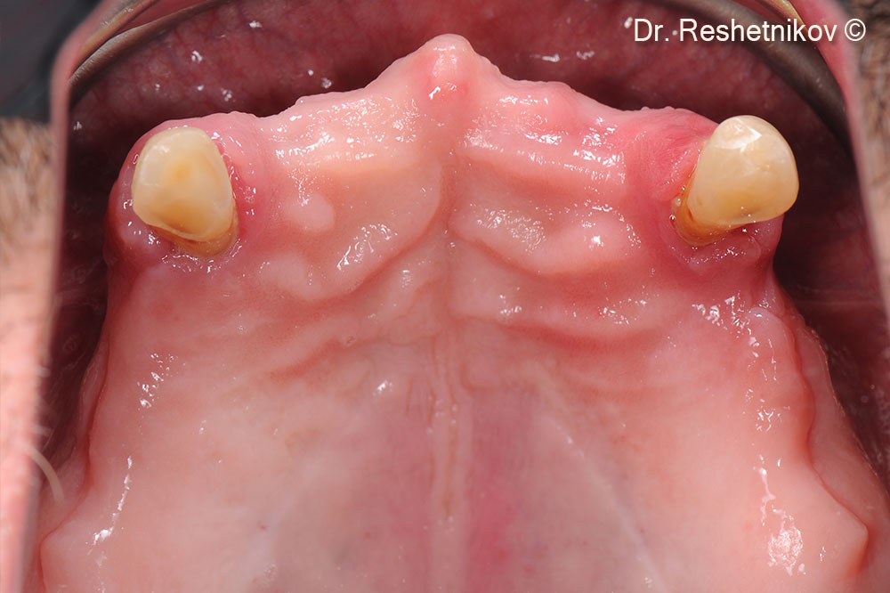 Alveolar ridges of the upper jaw atrophied unevenly