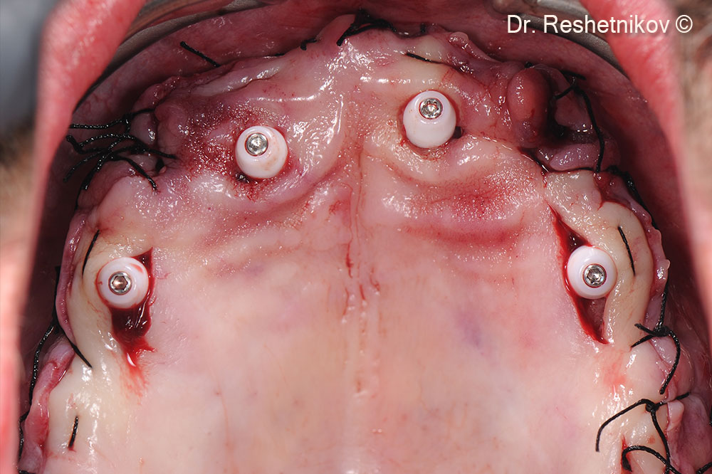 Four holes made in the palatal flap to uncover the abutments and improve the quality of soft tissues around them. Suturing around installed abutments