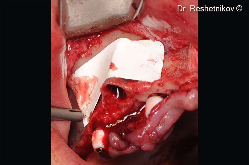 Void between the anterior wall of maxillary sinus and the Schneiderian membrane filled with OsteoBiol® mp3®. Bilateral approaches to the maxillary sinuses were closed with the collagen membrane OsteoBiol® Evolution 