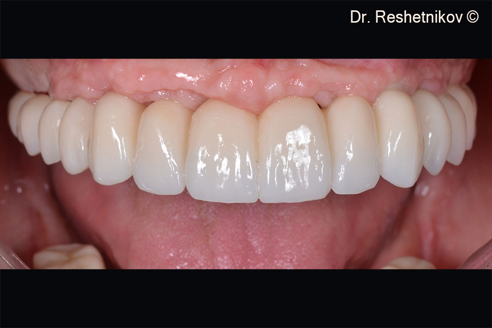 Installation of a permanent prosthesis using the FP2 protocol