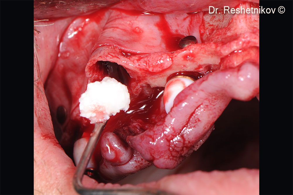 To prevent retraction of the socket walls it was filled with OsteoBiol ® mp3®