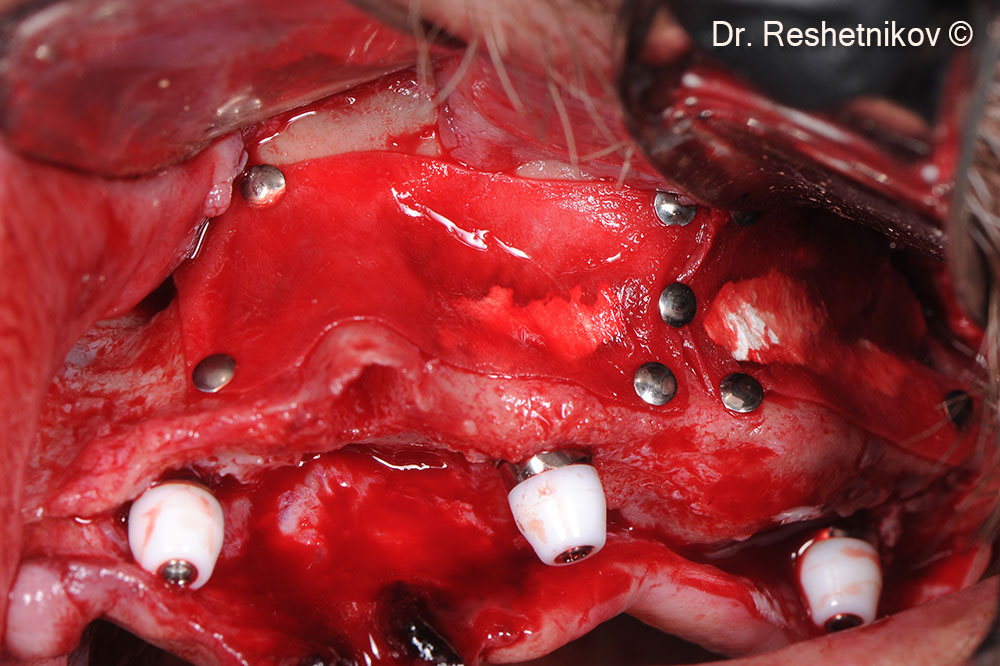 Void between the anterior wall of maxillary sinus and the Schneiderian membrane filled with OsteoBiol® mp3®. Bilateral approaches to the maxillary sinuses were closed with the collagen membrane OsteoBiol® Evolution 