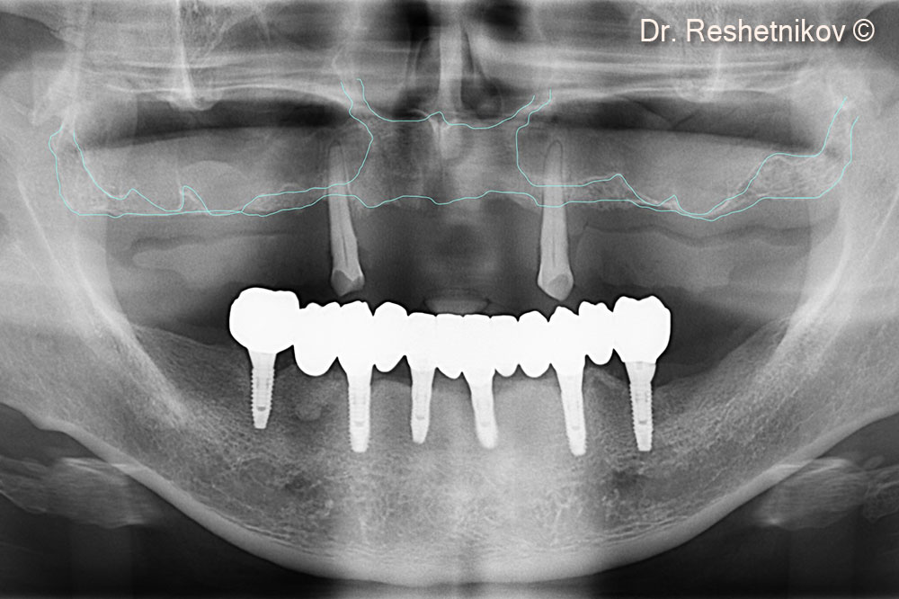 Panoramic radiograph shows pronounced pneumatization of the maxillary sinuses and atrophy of the alveolar ridge of the maxilla. Their edges highlighted in blue