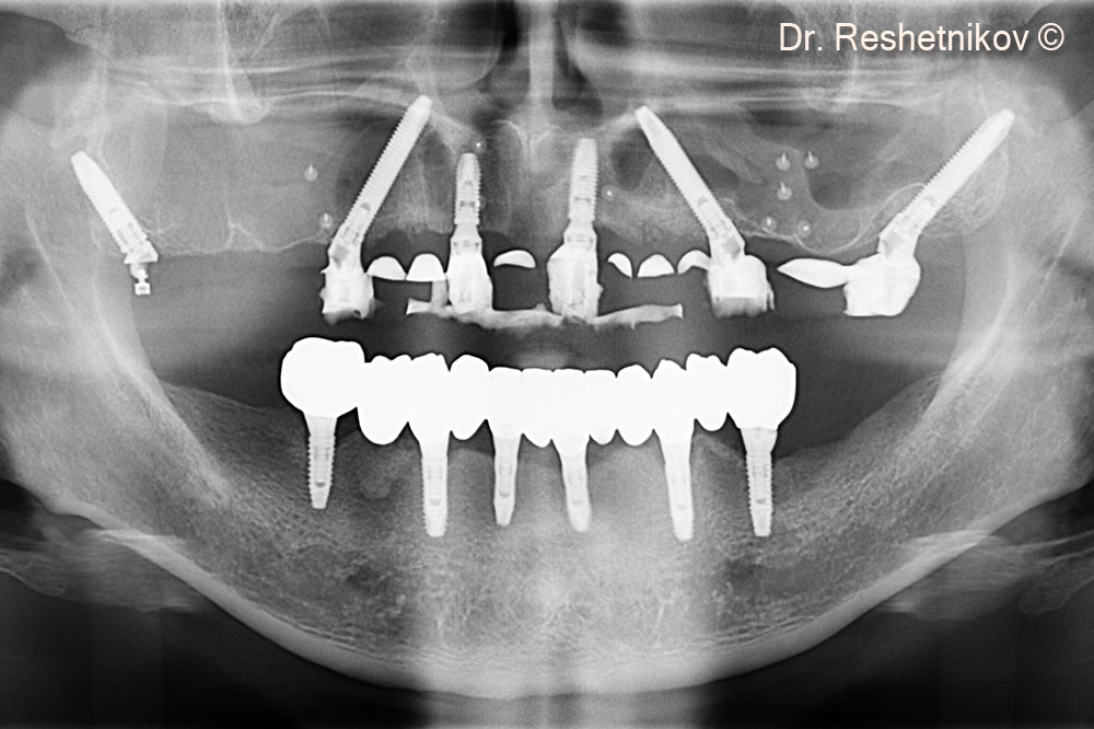 Final panoramic radiograph after implantation in the upper jaw