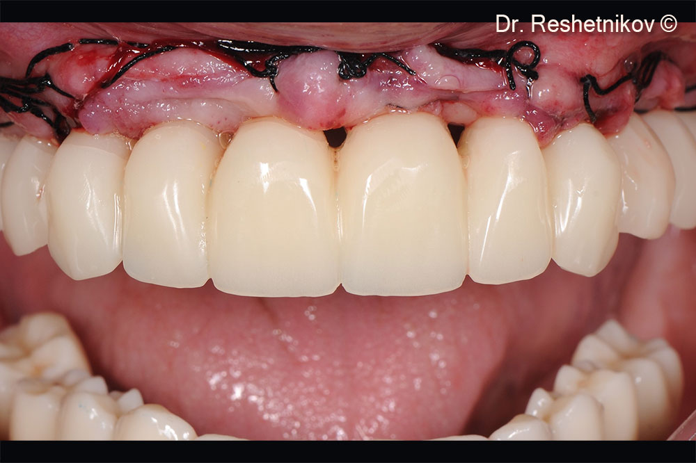 Temporary prosthesis fixed to achieve aesthetic and functional results and to form adequate occlusion on the day of surgery