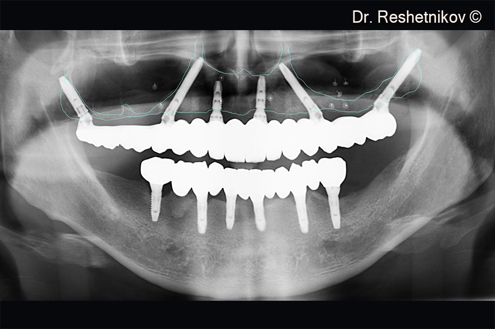 Panoramic radiograph 6 months after implantation with a permanent prosthesis installed on the upper jaw. The new edges of maxillary sinuses and alveolar ridge of the upper jaw highlighted in blue