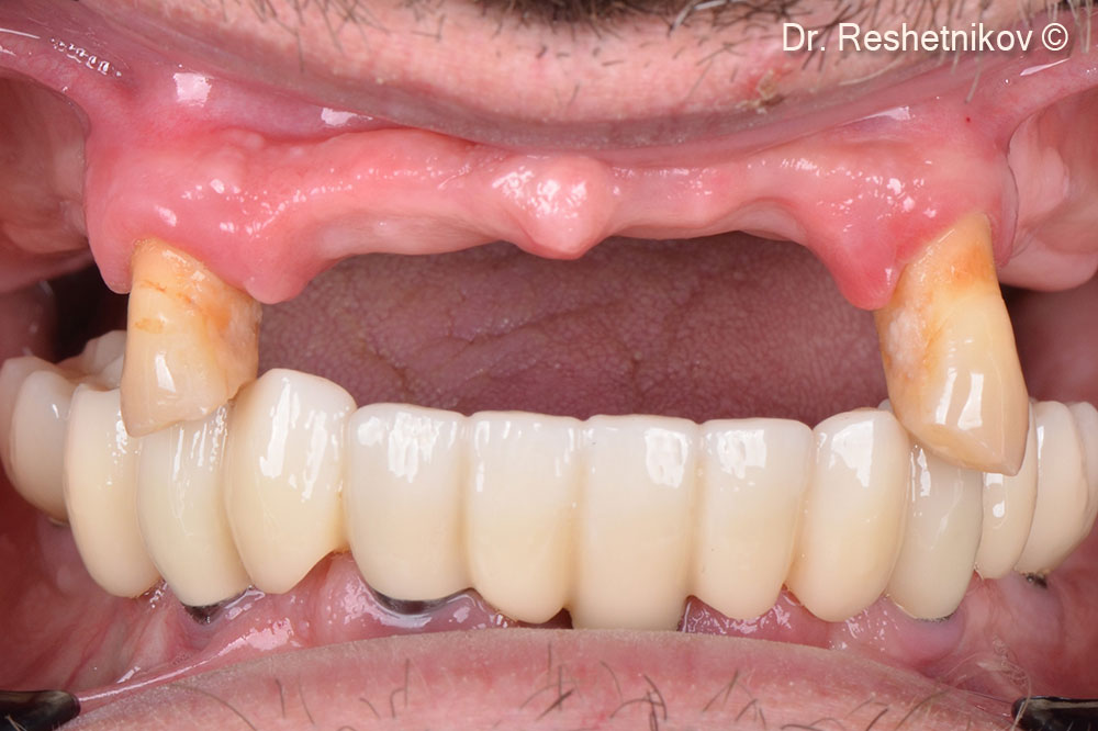 Alveolar ridges of the upper jaw atrophied unevenly