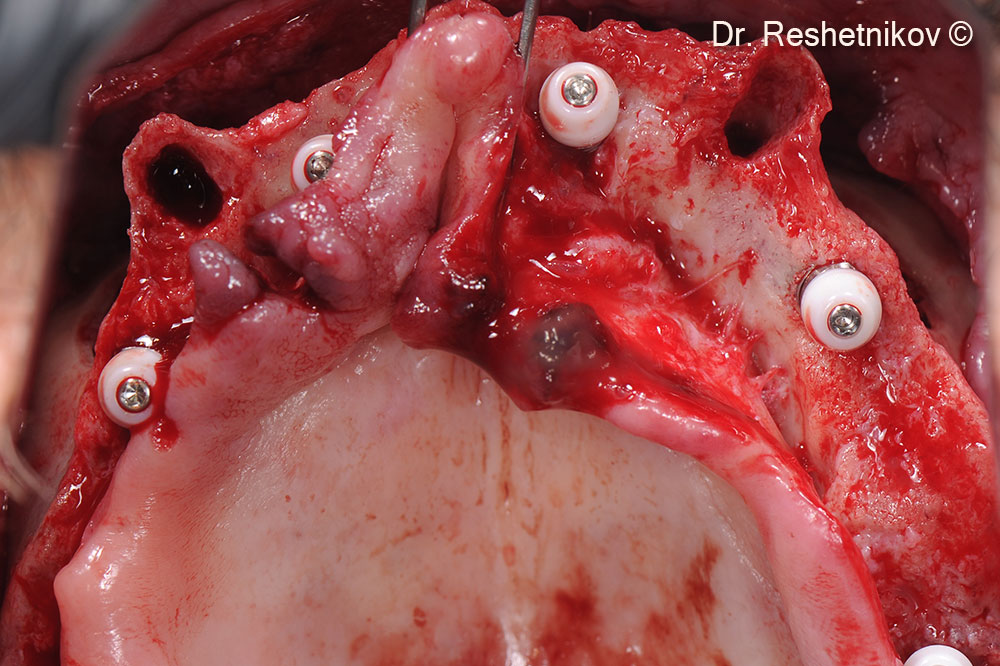 Inclined implants installed  transsinusally using the “All-on-4” protocol