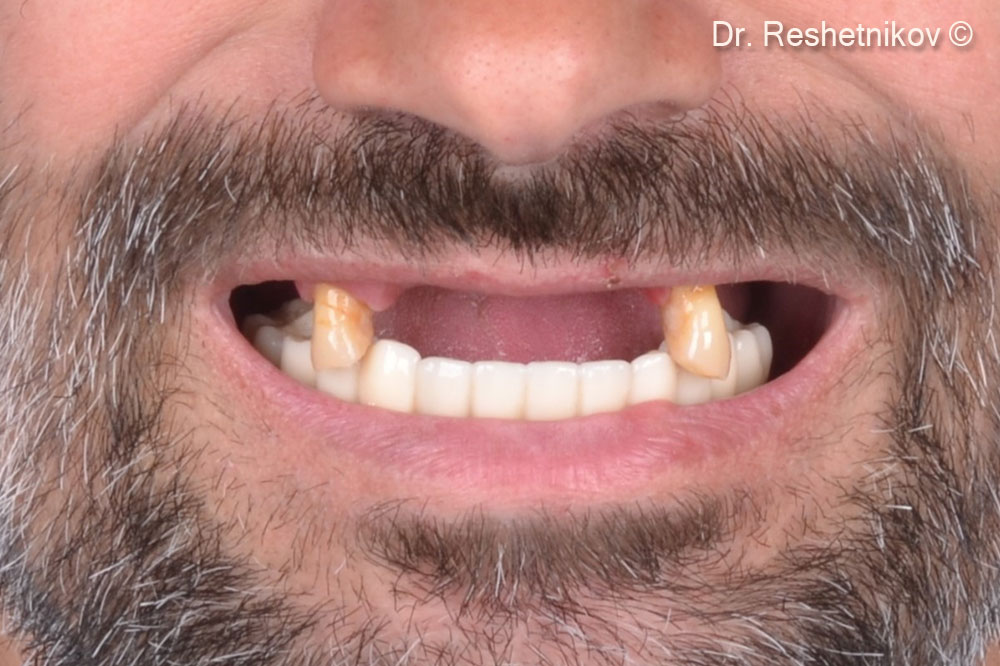 Lack of teeth in the upper jaw and aesthetic dissatisfaction with the removable denture