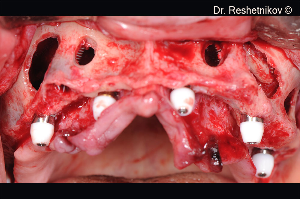 After infiltration anesthesia, teeth #13 and #23 removed, vestibular incision made and the mucoperiosteal flap skeletonized. Formed access to the anterior and lateral walls of both maxillary sinuses with mobilization of the Schneiderian membrane