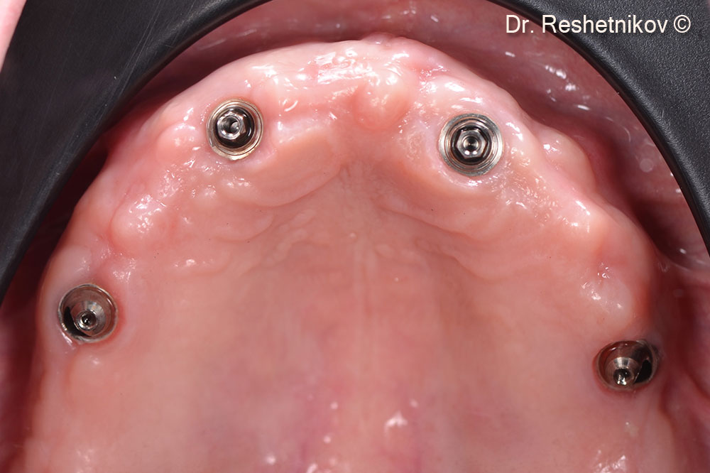 Check-up 6 months after implantation. Stable condition of soft tissues around installed abutments