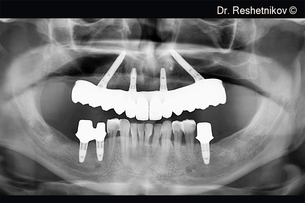 Panoramic radiograph 8 months after implantation with a permanent prosthesis installed on the upper jaw