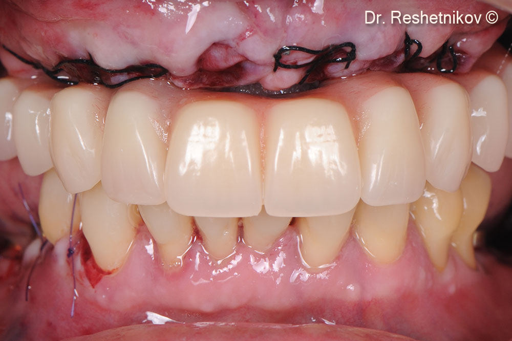 Immediate temporary restoration of the upper jaw