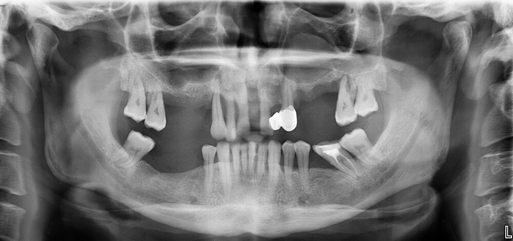 Panoramic radiograph. The upper anterior teeth lack the periodontal ligament and bone tissue along the entire length of the tooth roots