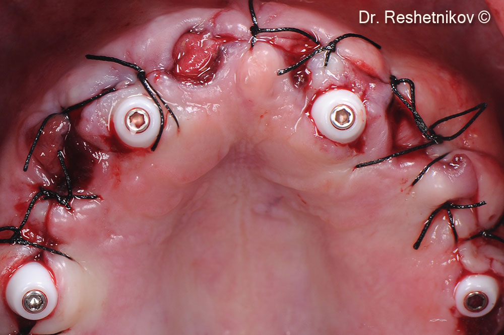 Edges of the wound sutured