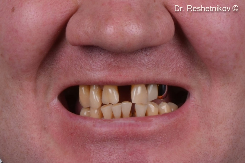 Mobility and lack of teeth in the upper jaw and aesthetic dissatisfaction 