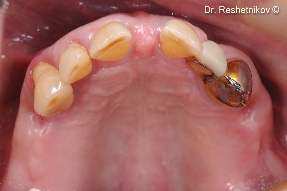 Gingival recession and decreased height of interdental papillae