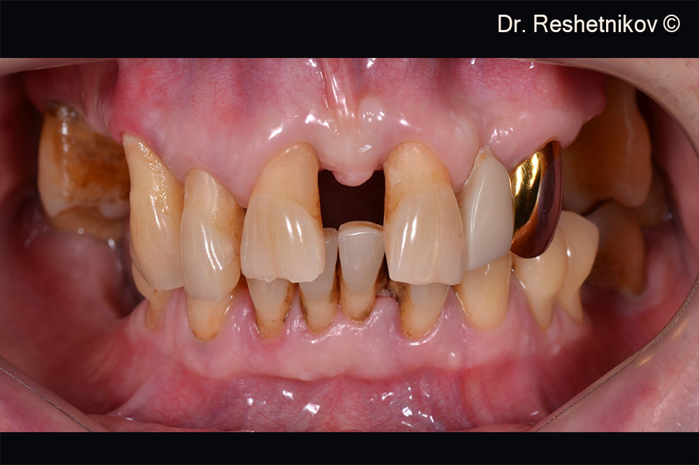 Gingival recession and decreased height of interdental papillae