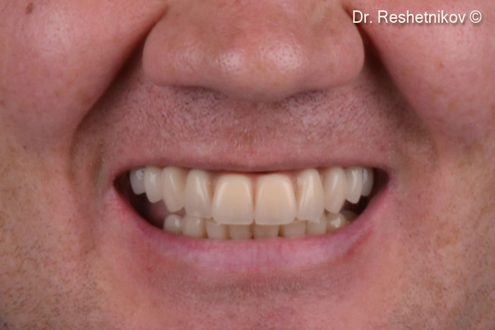 Patient’s smile with a temporary prosthesis installed immediately after surgery