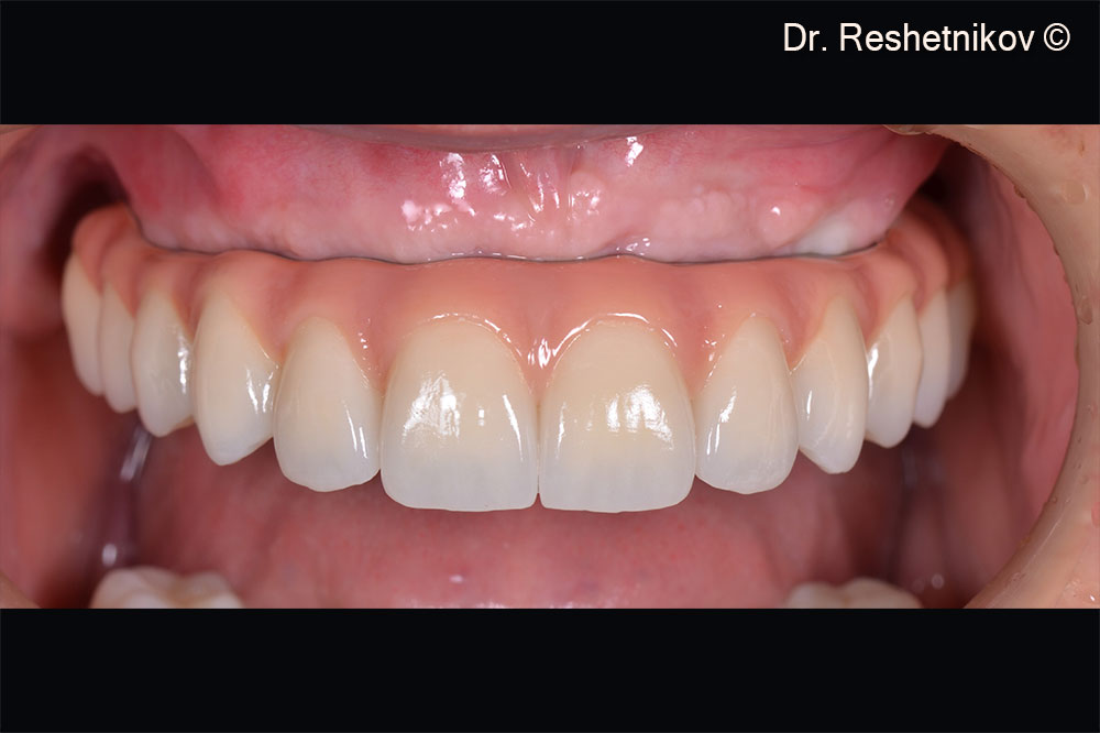 Permanent prosthesis fixed 8 months after the treatment started