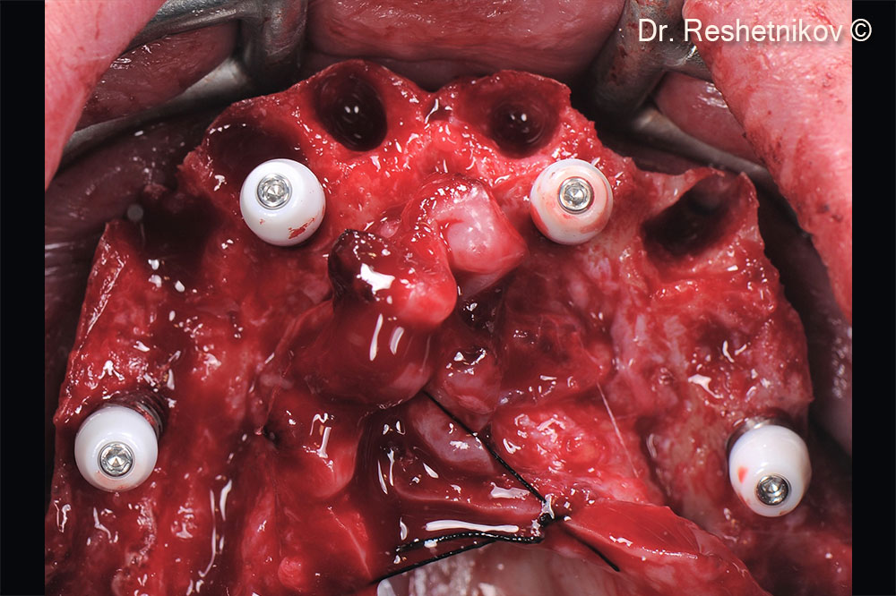 After infiltration anesthesia, all teeth  in the upper jaw removed, then vestibular incision made and the mucoperiosteal flap skeletonized. Implants installed using the “All-on-4” protocol