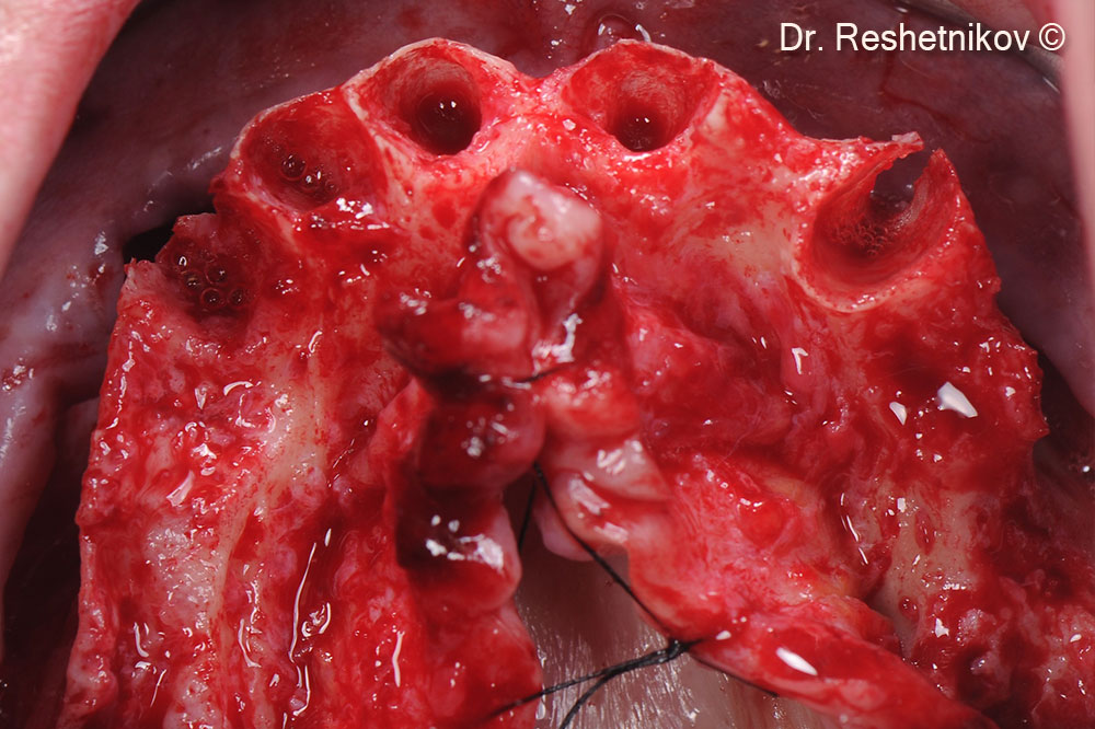 After infiltration anesthesia, all teeth  in the upper jaw removed, then vestibular incision made and the mucoperiosteal flap skeletonized. Implants installed using the “All-on-4” protocol