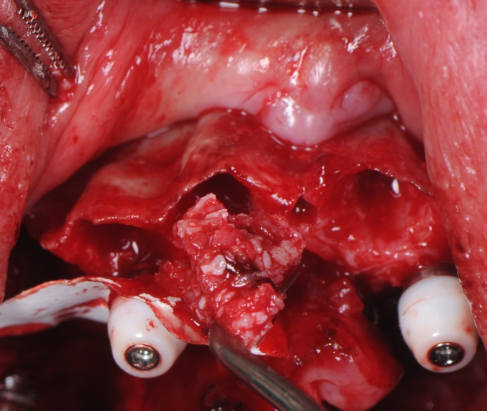 Treatment of an atrophic upper jaw with...
