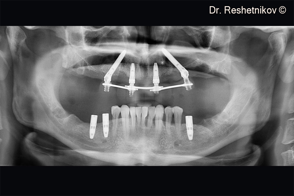 Panoramic radiograph on the day of surgery with a temporary reinforced plastic prosthesis installed