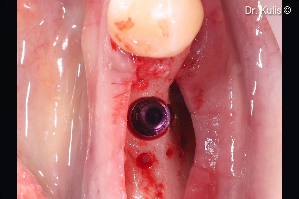 Implant placement. Note exposed implant threads and absence of the sufficient amount of buccal peri-implant bone