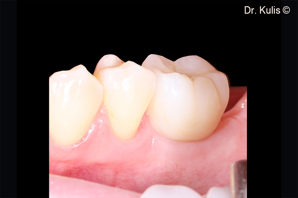 Definitive all-ceramic restoration 