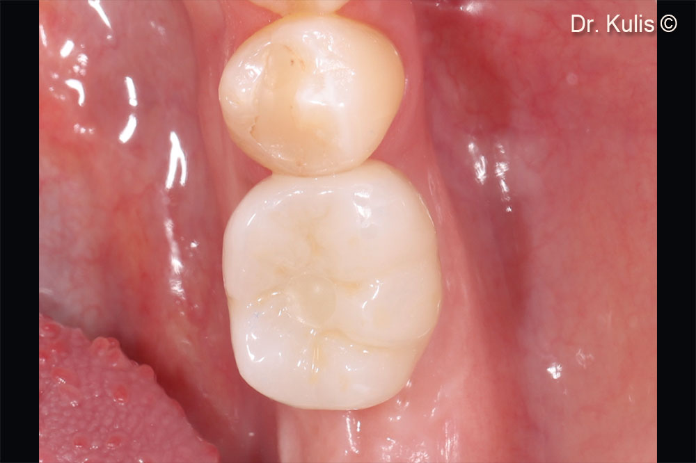 Definitive all-ceramic restoration and natural tooth-like gingival contour 