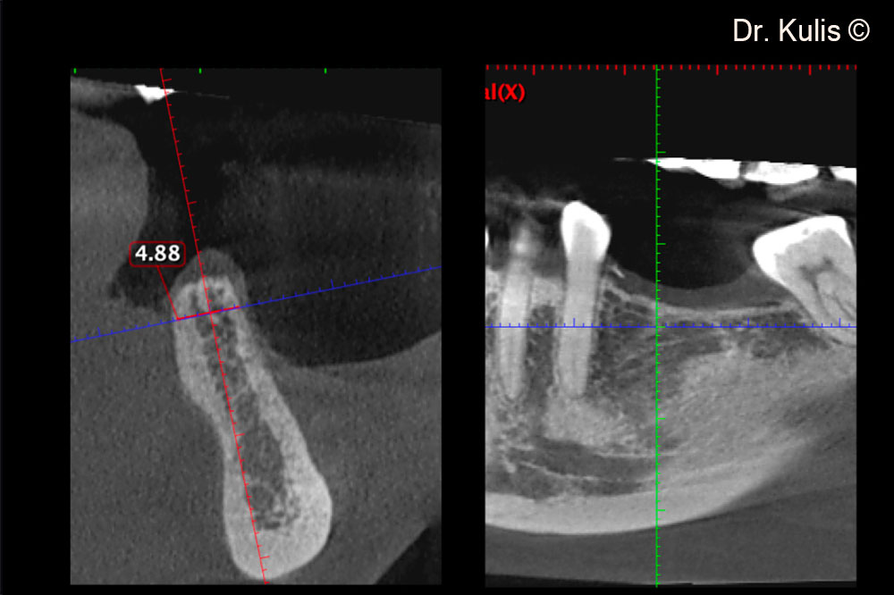 CBCT scan of the initial situation displays horizontal bone deficiency of the alveolar ridge