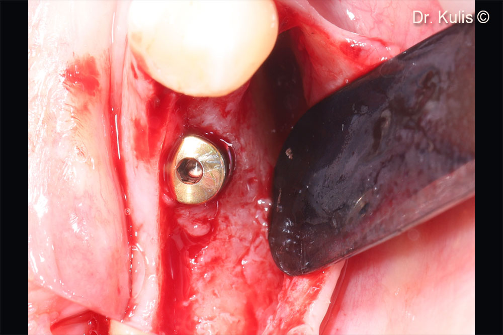 Second stage surgery. Situation after 5 months of healing.
