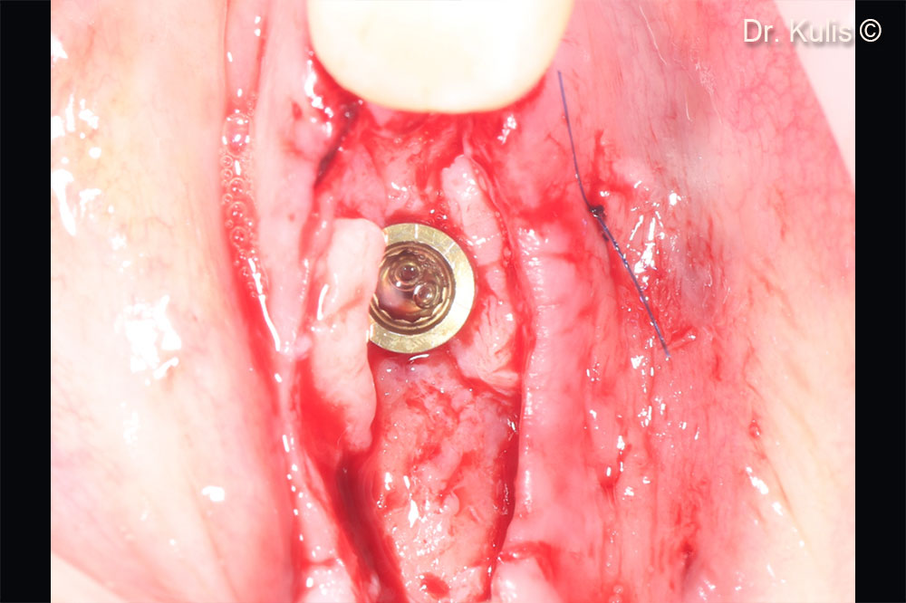 Soft tissue augmentation using connective tissue graft for a buccal and lingual flap