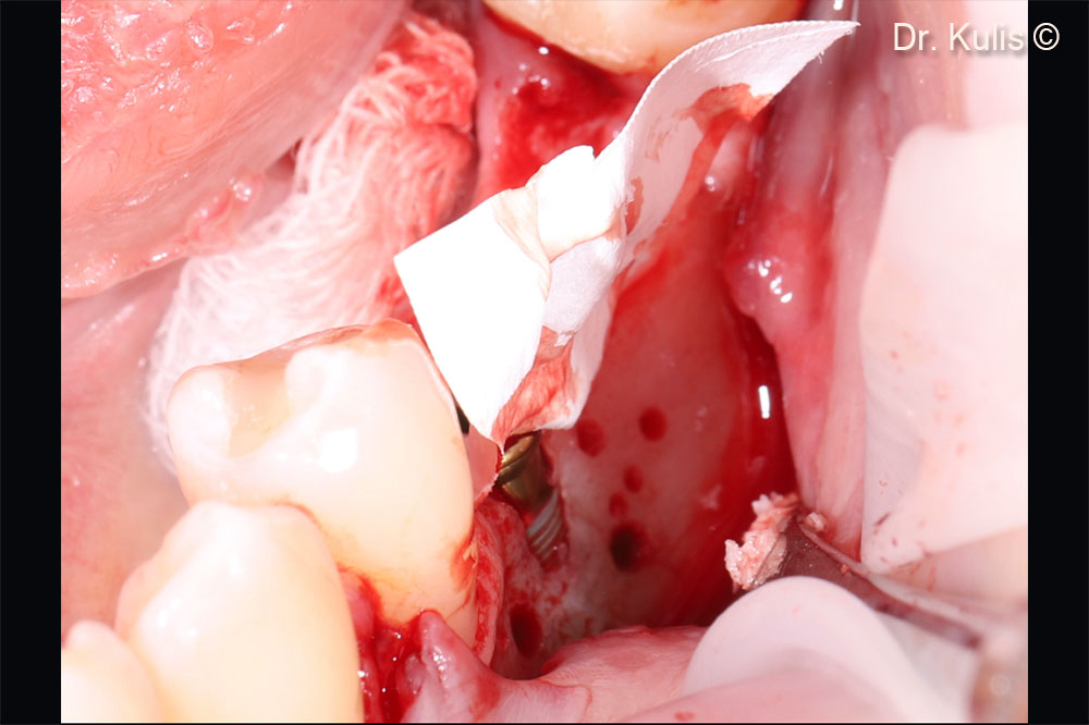 Horizontal bone augmentation and...