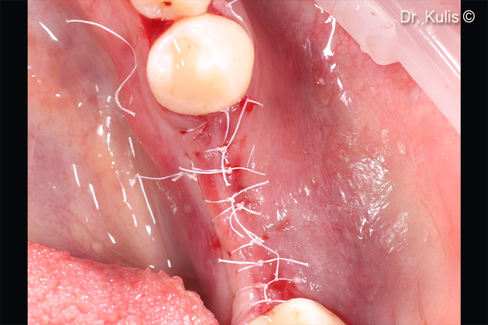 Suturing