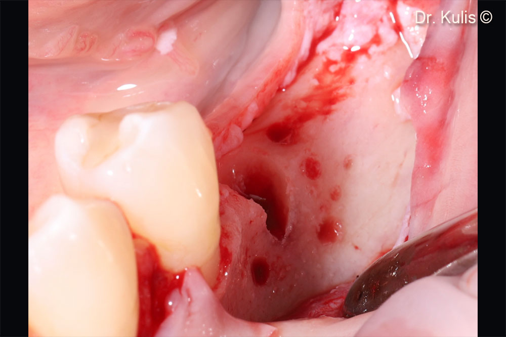 Alveolar ridge after osteotomy preparation for a implant and cortical bone perforations