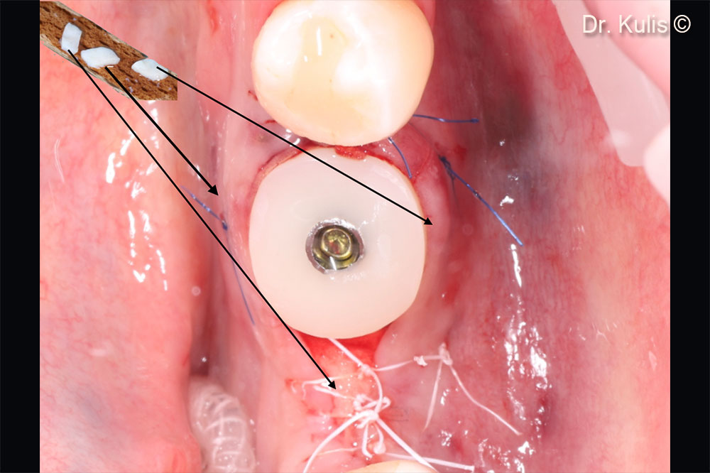 Soft tissue reconstruction with anatomical healing abutment and 3 pieces of connective tissue graft