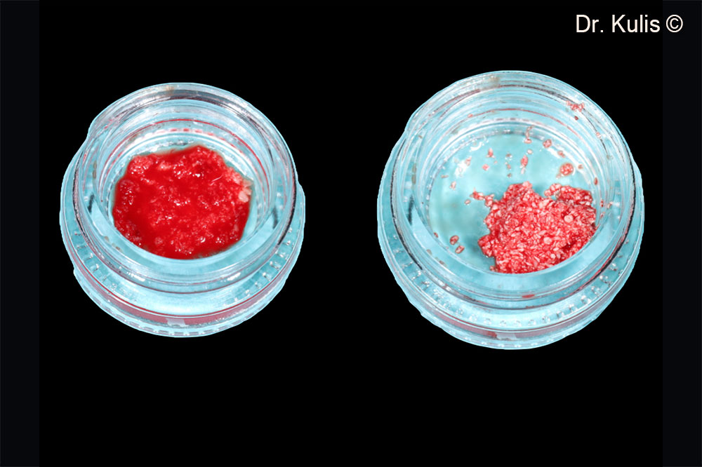 Mixture of the Gen-Os® a and autologous bone