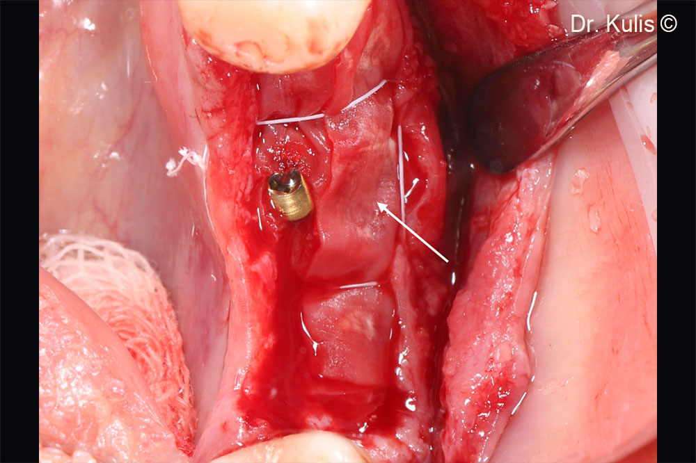 Bone augmentation with Gen-Os®. Second layer of the Evolution membrane  (arrow). The flap design results in a periosteal pocket formation, which allows that the graft-membrane complex was covered with periosteum and  stabilised with periosteal sutures