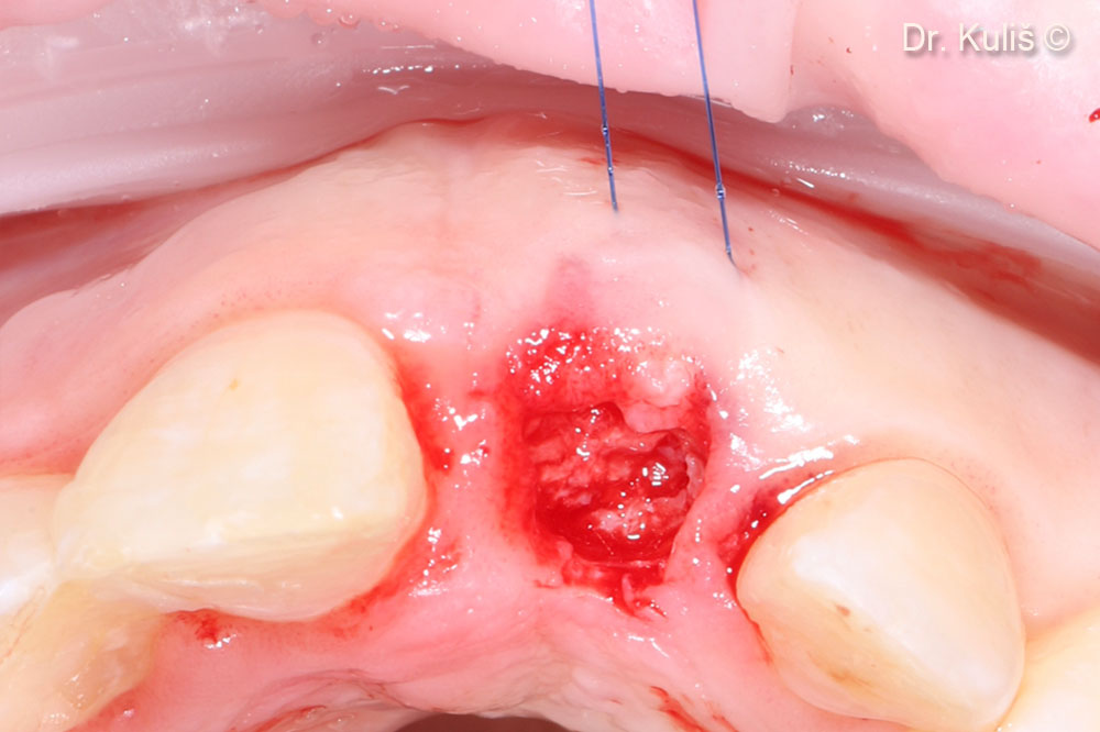 Second stage surgery was performed minimally invasive manner with roll flap technique. The picture presents nice bone formation above the implant platform