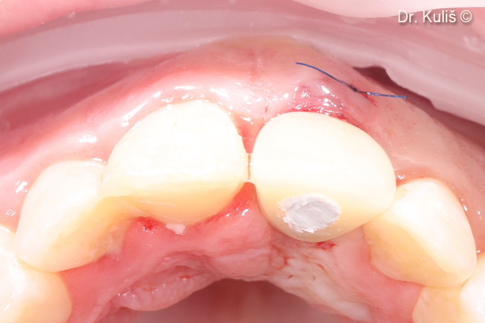 Provisional restoration was delivered immediately after implant uncovering