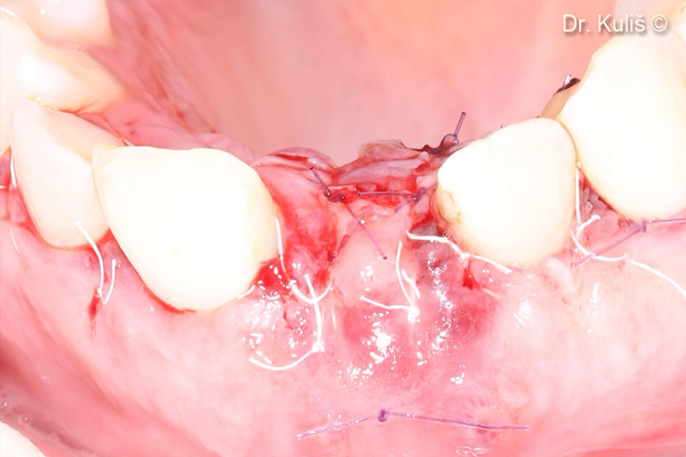 The membrane and orificie of the extraction socket was covered with palatal pedicle flap