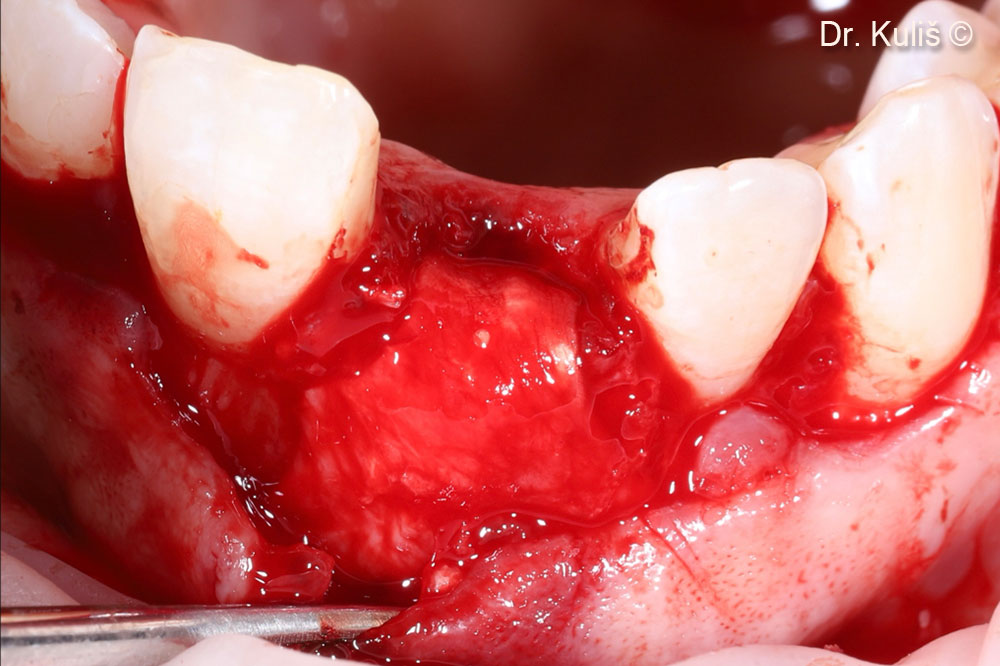 The Evolution membrane has been adapted to the defect