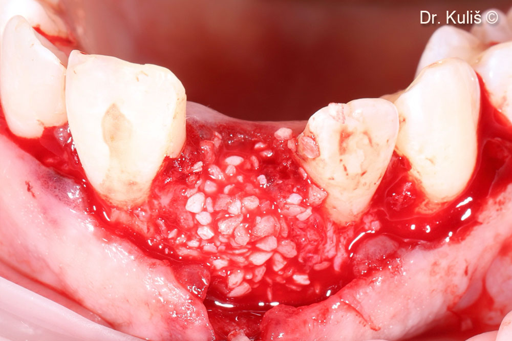 Single implant placement in aesthetic...