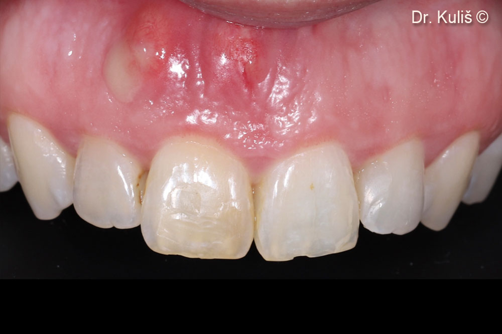 Initial situation. Purulent exudate due to periapical lesion on the right central incisor