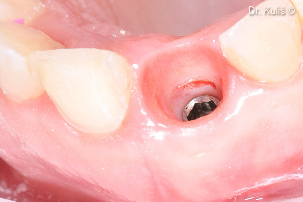 Emergence profile and implant supracrestal complex