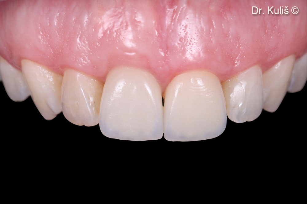 Final result 6 months after placement of the final all-ceramic restoration
