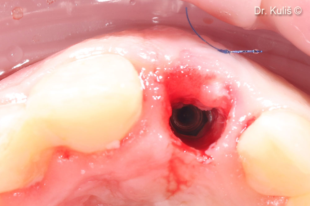 Second stage surgery was performed minimally invasive manner with roll flap technique. The picture presents nice bone formation above the implant platform